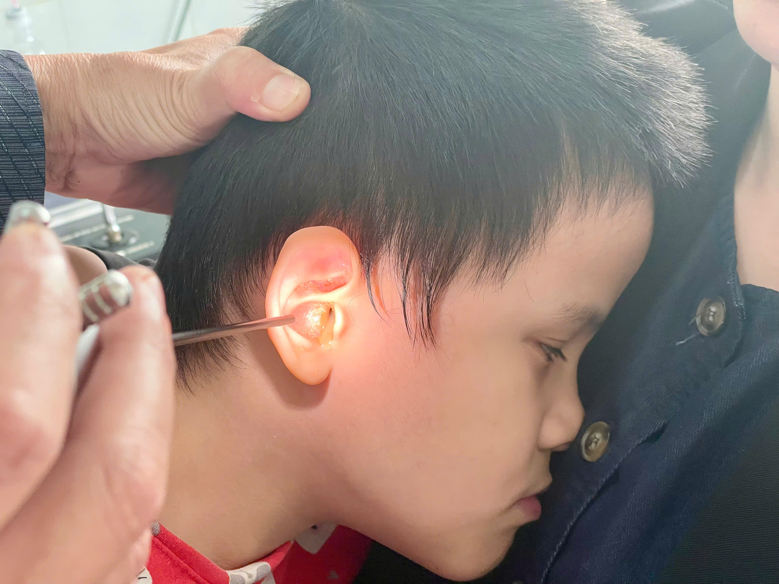 Gia tăng ca viêm tai giữa mủ ở trẻ em: Cảnh báo từ Bệnh viện Nhi tỉnh Gia Lai